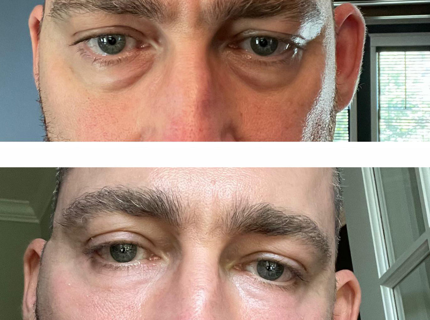 Tphflare-Eye Repair Patches for Men