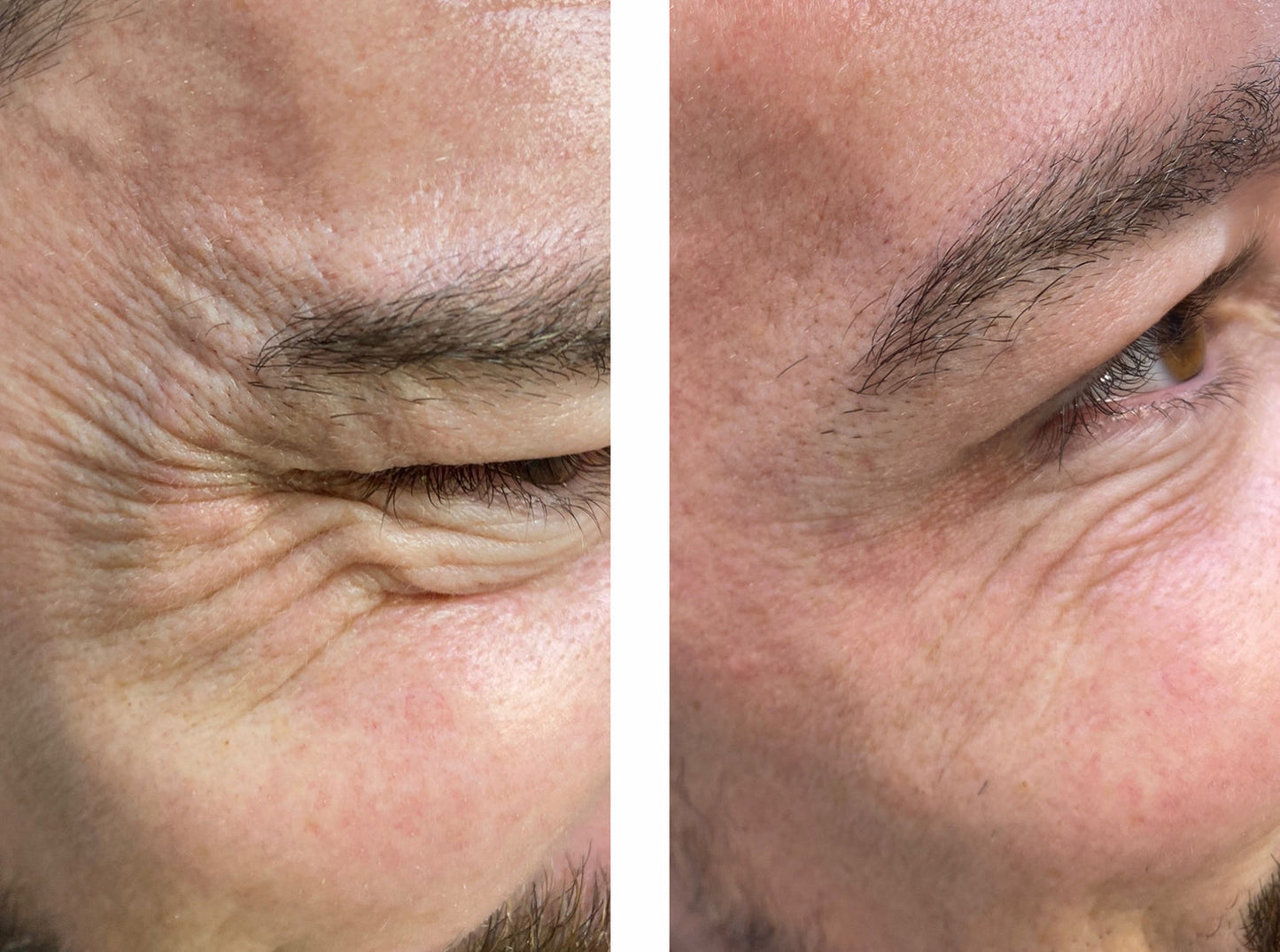 Tphflare-Eye Repair Patches for Men